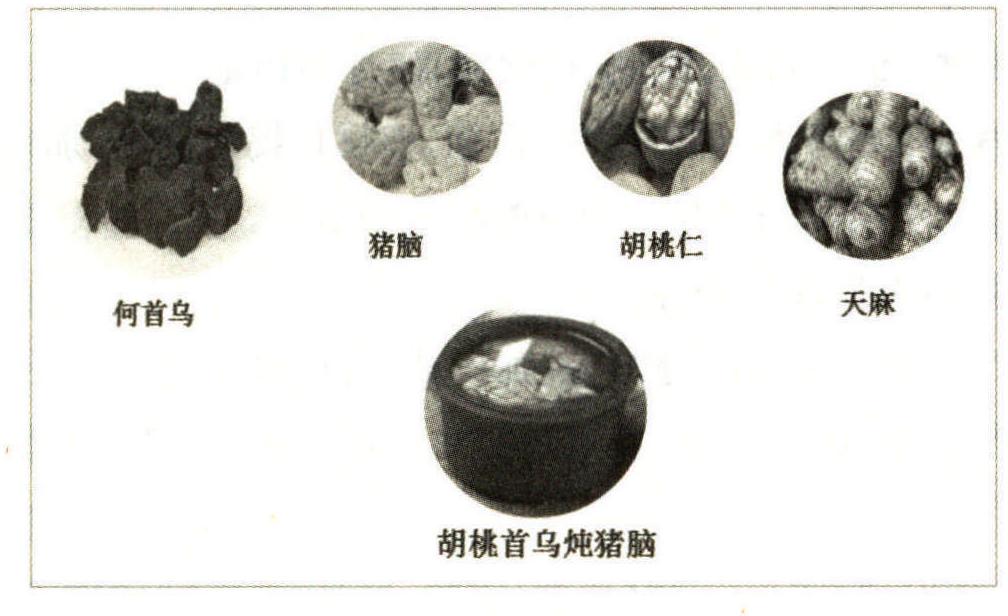 癡呆(血管性癡呆)